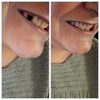 Teeth Gap Filler