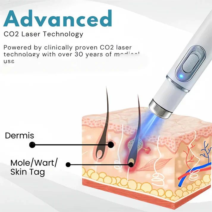 Non-Invasive Acne & Wart Removal Laser Pen with Heating (No Side Effect)